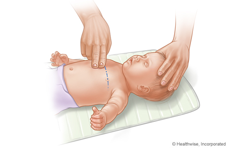 RCP en bebé, donde se muestra la ubicación de dos dedos sobre el esternón.