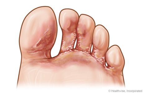 Pie de atleta de tipo vesicular entre los dedos del pie