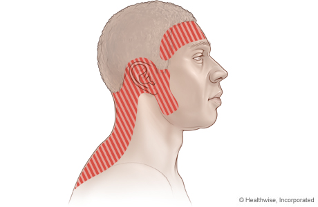 Imagen de posibles zonas de dolor con un dolor de cabeza por tensión