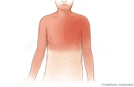 Imagen de zonas comunes donde se pueden sentir síntomas de angina