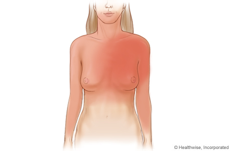Imagen de las zonas más comunes en las que se sienten los síntomas de angina