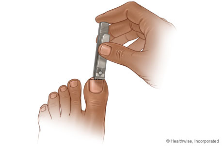 Imagen de cómo cortar las uñas de los dedos de los pies