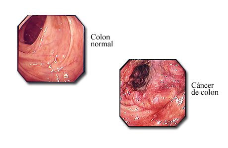 Cáncer de colon visible con un colonoscopio