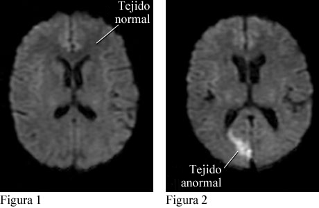 Imágenes por resonancia magnética de un ataque cerebral