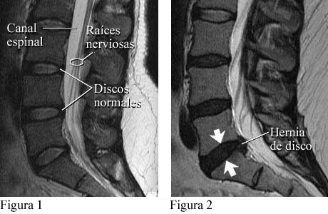 Imágenes de discos normales y de una hernia de disco