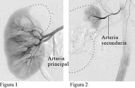 Imagen de angiografía del suministro arterial al riñón izquierdo