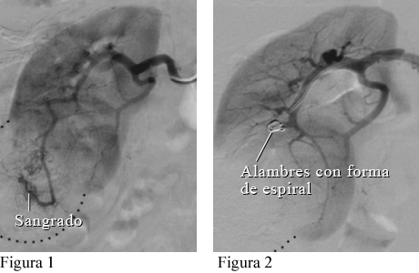 Imagen de angiografía de una masa renal