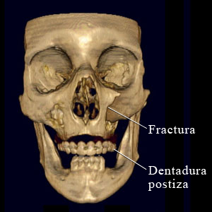 Tomografía computarizada de una fractura facial
