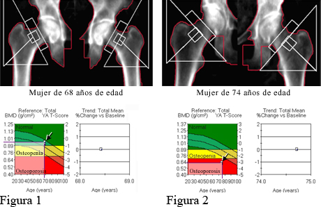 DXA de huesos de la cadera normales y DXA de huesos de la cadera con osteoporosis