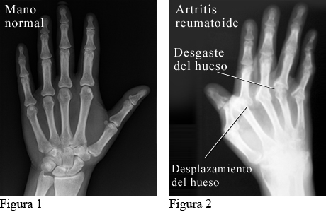 Radiografía que muestra artritis reumatoide en las manos