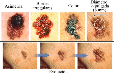 Los ABCDE del cáncer de piel melanoma | Cigna