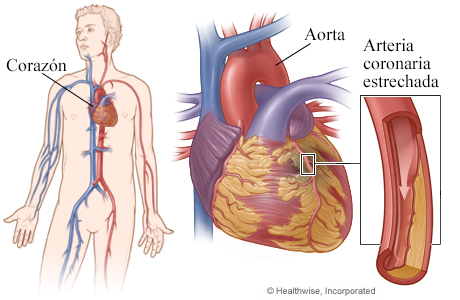 Corazón, con detalle de arteria coronaria estrechada por placa
