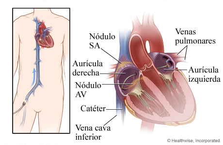 Cómo se inserta un catéter a través de una vena hasta el corazón