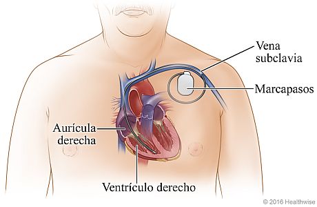 Ubicación del marcapasos en la parte superior izquierda del pecho, que muestra su derivación a través de la vena subclavia y dentro del ventrículo derecho