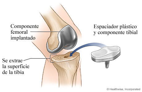 Artroplastia de rodilla: Componente tibial