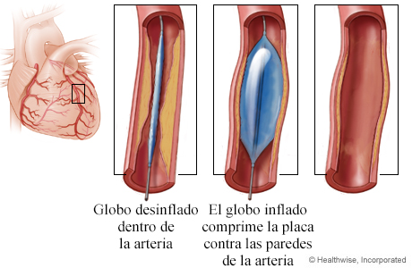 Globo desinflado y globo inflado en una arteria estrechada, y una arteria que se ha ensanchado