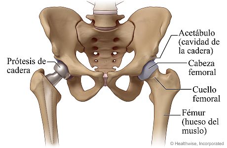 Cadera con prótesis parcial de cadera y cadera normal que muestra la cavidad de la cadera, la cabeza y el cuello femoral, y el fémur