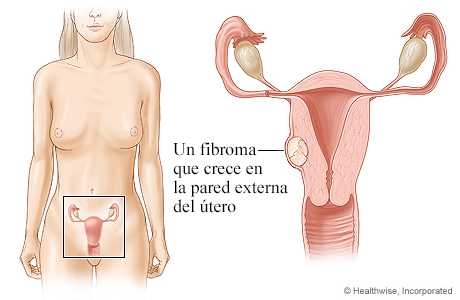 Ubicación del útero y los ovarios, con detalle de un fibroma que crece en la pared externa del útero