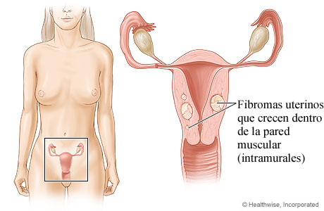Ubicación del útero y los ovarios, con detalle de fibromas que crecen dentro de la pared uterina