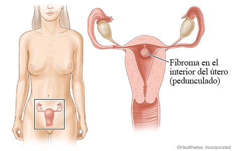 Ubicación del útero y los ovarios, con detalle de un fibroma que crece en la pared interna del útero