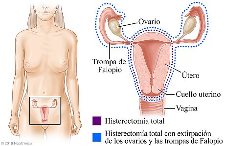 Histerectomía total e histerectomía total con extirpación de los ovarios y las trompas de Falopio