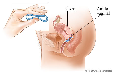 Método anticonceptivo de anillo vaginal