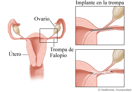 Imagen de implantes en las trompas como método anticonceptivo permanente