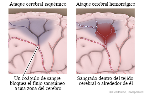 Ataque cerebral isquémico donde se muestra coágulo de sangre obstruyendo flujo de sangre a la región del cerebro y un ataque cerebral hemorrágico que muestra sangrado dentro o alrededor del tejido cerebral