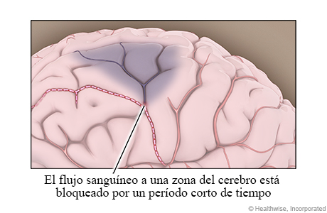 El flujo sanguíneo a una zona del cerebro está bloqueado por un período corto de tiempo
