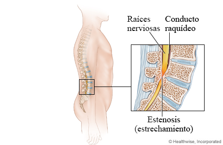 Imagen de la estenosis espinal lumbar