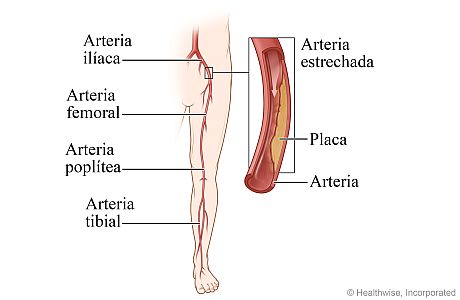 Imagen de enfermedad arterial periférica de las piernas