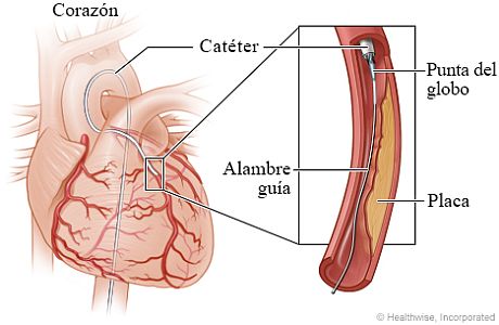 Alambre guía y punta del globo en una arteria estrecha