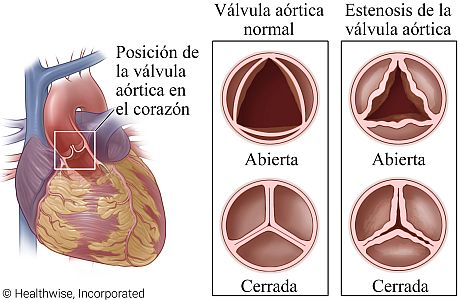 Ubicación de la válvula aórtica en el corazón con detalle de válvula normal abierta y cerrada y una con estenosis