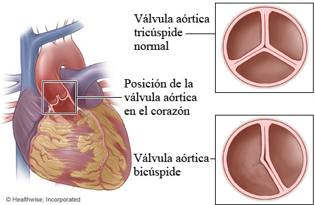 Ubicación de la válvula aórtica en el corazón, con detalles de una válvula tricúspide y una válvula bicúspide