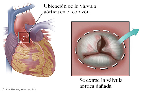Ubicación de la válvula aórtica en el corazón con detalle de la válvula dañada