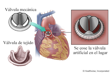 Válvula mecánica y válvula de tejido; se muestra la válvula mecánica en el corazón, con detalle de la válvula cosida en su lugar