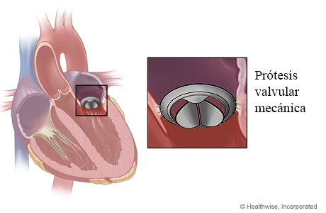 Válvula mitral mecánica en el corazón con primer plano de la válvula sustituta mecánica