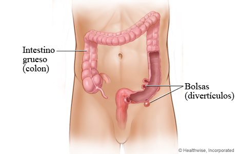Bolsas (divertículos) en el intestino grueso (colon)