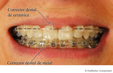 Boca de una persona con correctores dentales, que muestra correctores de cerámica arriba y correctores de metal abajo