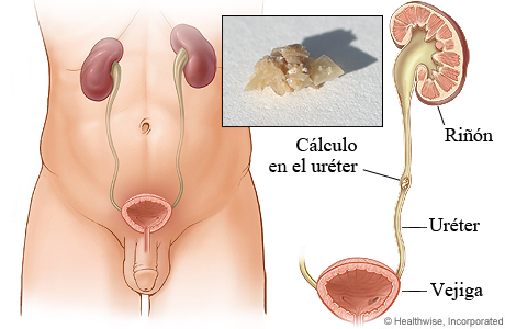 Un cálculo renal en el uréter