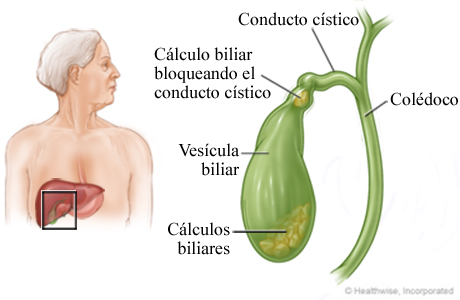 Vesícula biliar y cálculos biliares