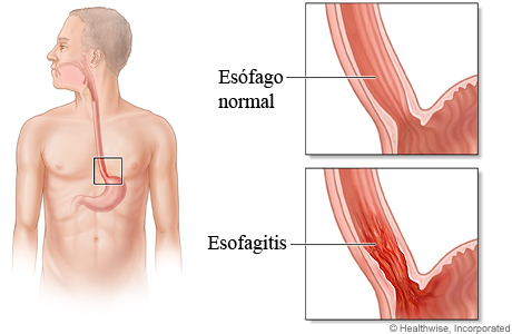 Esófago normal comparado con esofagitis