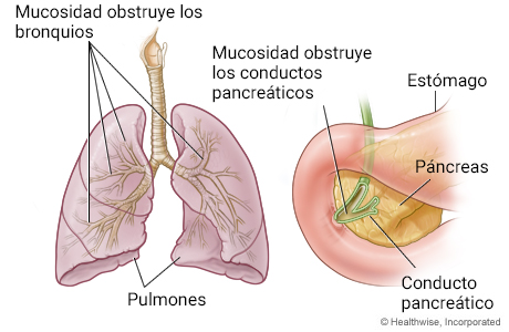 Órganos afectados con mayor frecuencia por la fibrosis quística (pulmones y páncreas)