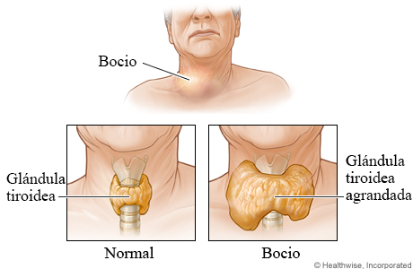 Vistas interiores de una glándula tiroidea de tamaño normal y una glándula tiroidea agrandada (bocio)