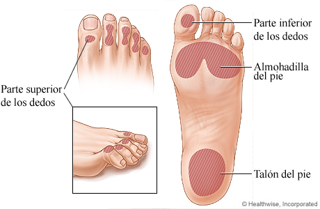 Lugares comunes de las úlceras del pie