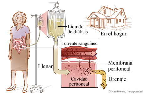 El proceso de diálisis peritoneal
