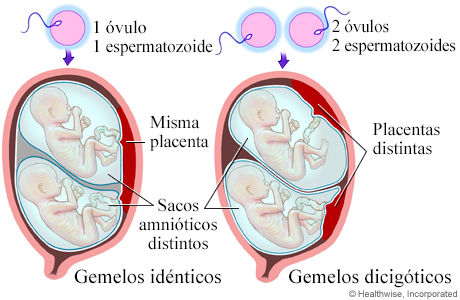 Tipos de embarazo gemelar