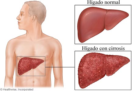 Imagen que muestra la ubicación del hígado en el cuerpo y una comparación del hígado normal con el hígado con cirrosis