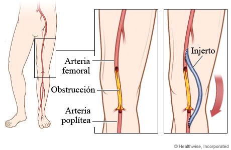 Arteria obstruida y posición del injerto en la derivación femoropoplítea