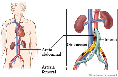 Arteria abdominal y arteria femoral con detalle de una obstrucción y de un injerto